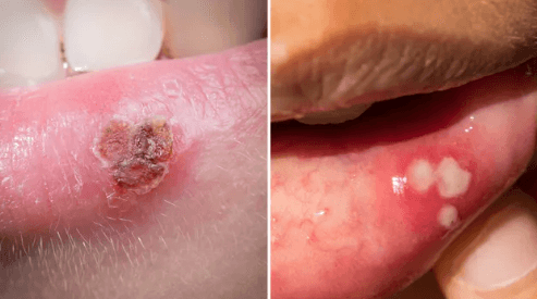Canker Sore